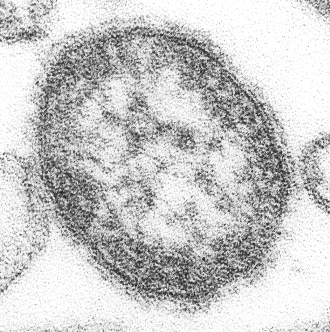 ABD'de kızamıktan üçüncü ölüm: Pennsylvania'da 40 yaşındaki kadın hayatını kaybetti