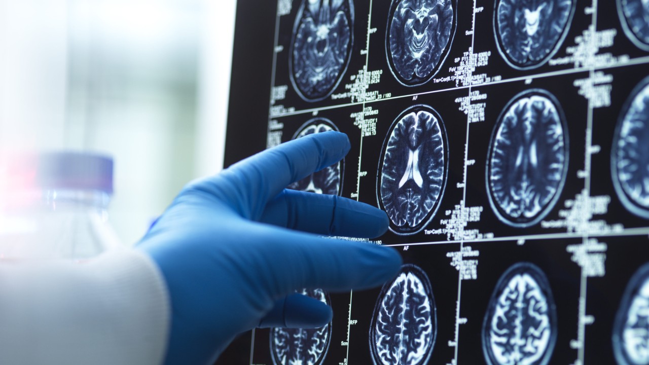 Alzheimer’da ameliyat umudu: Temel beceriler geri kazanılabilir mi