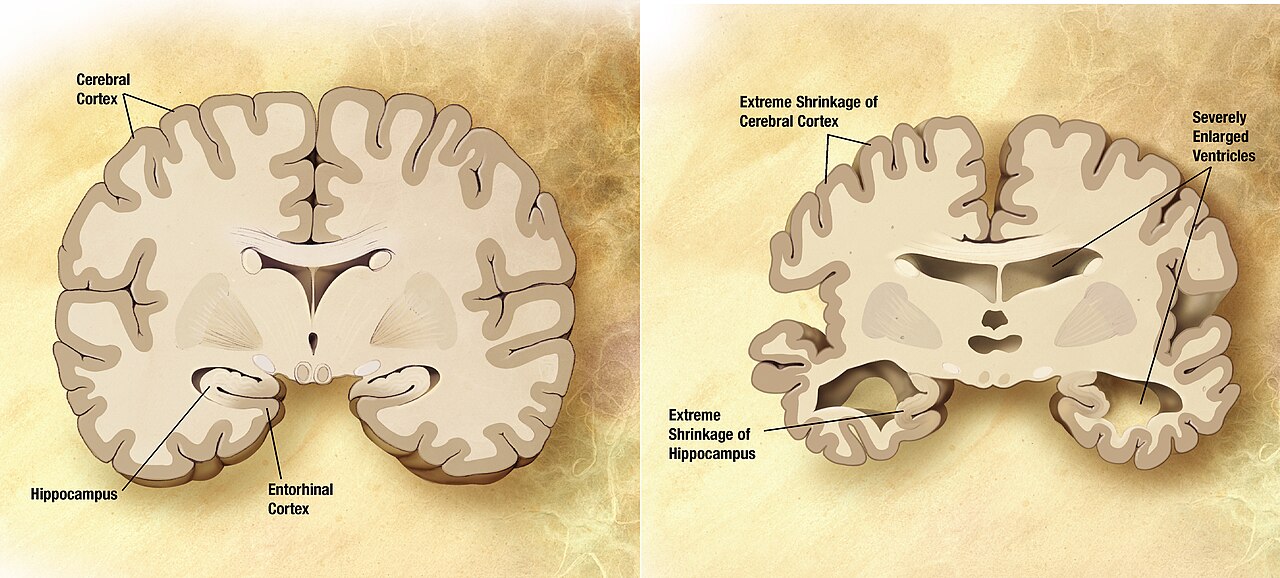 Alzheimer Hastalığının Yeni Tetikleyicisi Bulunmuş Olabilir