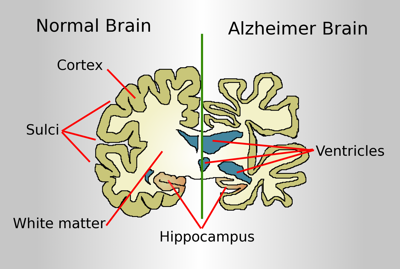 Alzheimer Kan Testleri Yüksek Riskli Gruplarda Erken Teşhisi Hızlandırabilir