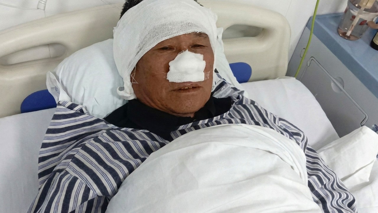 ‘Gerçek halk kahramanı’: 69 yaşındaki Çinli, kadını kurtarırken burnunu kaybetti