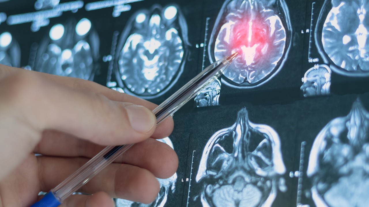 Çinli bilim insanları depresyon riskini 4 yıl önceden öngören yapay zeka geliştirdi