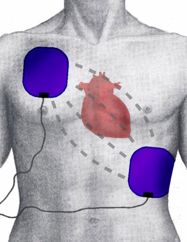 Defibrilatör Eksikliği 16 Milyon Kişiyi Risk Altına Sokuyor