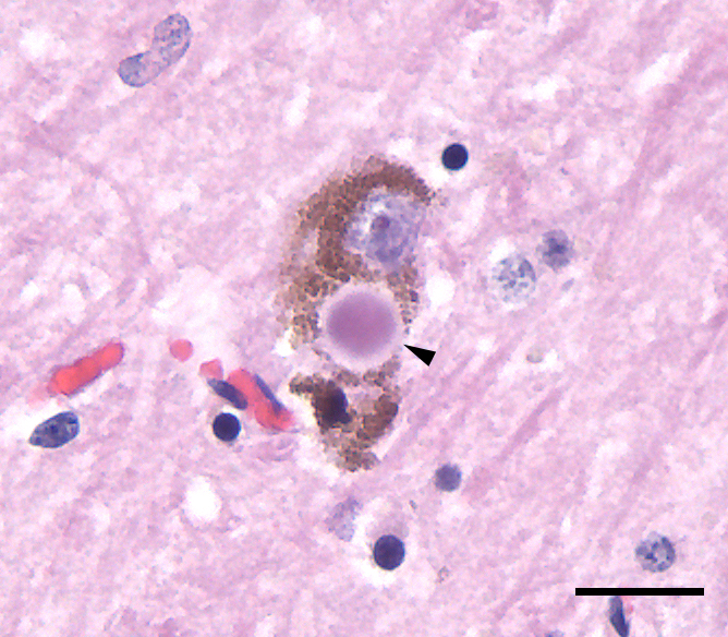 Deney İlacı Alzheimer Proteinlerini Temizleyip Hafızayı Geri Getirebilir