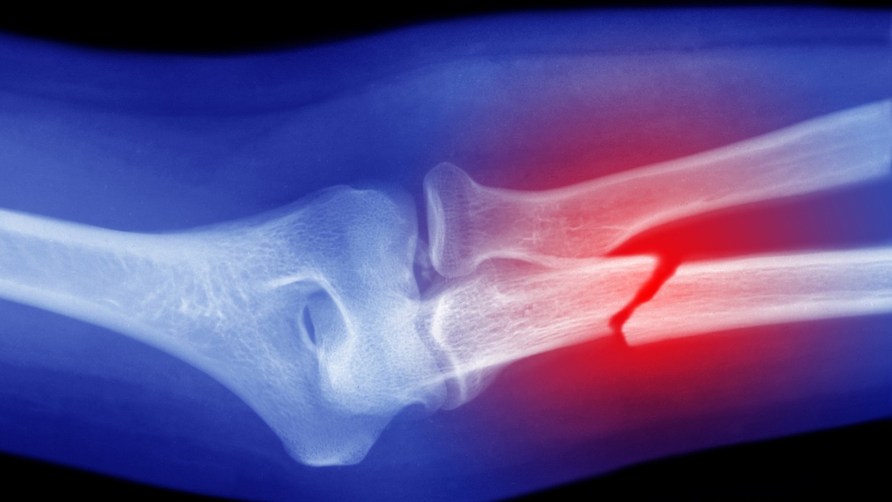 Hong Kong'da eczanelerde osteoporoz taraması başlıyor