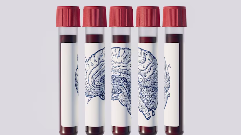 Kan testi ile Alzheimer yıllar önceden teşhis edilebilir mi