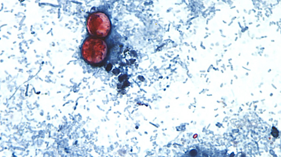 Michigan'da Cyclospora Vakaları Artıyor
