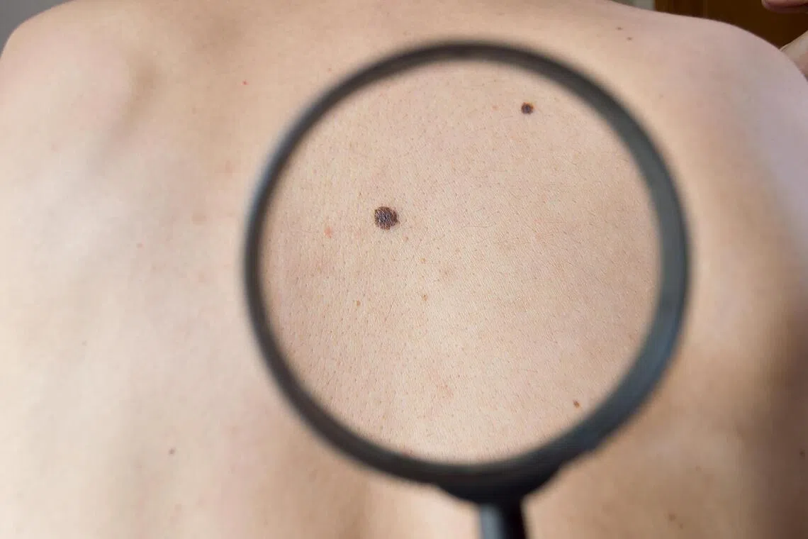 mRNA Kanser Aşısı Melanomda Çığır Açtı