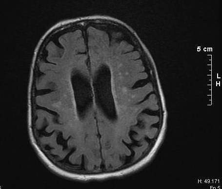 Yapay Zeka Uyku Testi Alzheimer'ı Erken Teşhis Edebilir