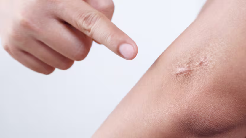 Yara İzleri Nasıl Geçer? Uzmanlar Silikon Bantlardan E Vitamini'ne Etkili Yöntemleri Açıkladı